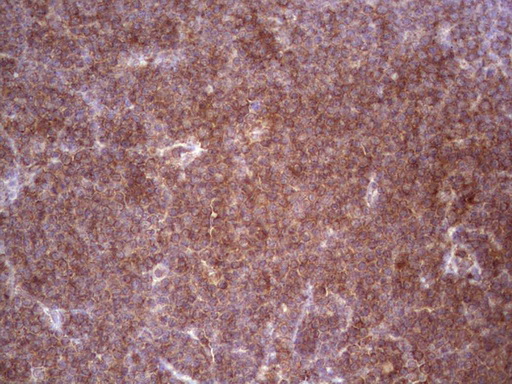 BHLHE41 / BHLHB3 / SHARP1 Antibody - Immunohistochemical staining of paraffin-embedded Human lymphoma tissue using anti-BHLHE41 mouse monoclonal antibody.  heat-induced epitope retrieval by 1 mM EDTA in 10mM Tris, pH8.5, 120C for 3min)
