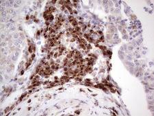 BHLHE41 / BHLHB3 / SHARP1 Antibody - Immunohistochemical staining of paraffin-embedded Carcinoma of Human lung tissue using anti-BHLHE41 mouse monoclonal antibody.  heat-induced epitope retrieval by 1 mM EDTA in 10mM Tris, pH8.5, 120C for 3min)
