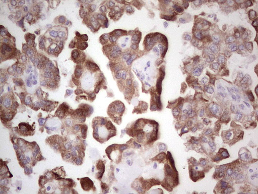 BHLHE41 / BHLHB3 / SHARP1 Antibody - IHC of paraffin-embedded Adenocarcinoma of Human ovary tissue using anti-BHLHE41 mouse monoclonal antibody. (heat-induced epitope retrieval by 1 mM EDTA in 10mM Tris, pH8.5, 120°C for 3min).