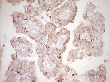 BHLHE41 / BHLHB3 / SHARP1 Antibody - Immunohistochemical staining of paraffin-embedded Adenocarcinoma of Human ovary tissue using anti-BHLHE41 mouse monoclonal antibody. (Heat-induced epitope retrieval by 1 mM EDTA in 10mM Tris, pH8.5, 120C for 3min,