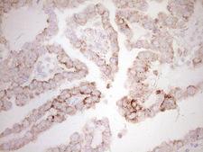 BHLHE41 / BHLHB3 / SHARP1 Antibody - IHC of paraffin-embedded Adenocarcinoma of Human ovary tissue using anti-BHLHE41 mouse monoclonal antibody. (Heat-induced epitope retrieval by 1 mM EDTA in 10mM Tris, pH8.5, 120°C for 3min).