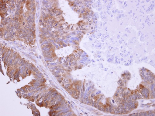 BHMT Antibody - BHMT antibody detects BHMT protein at cytosol on Colon Carcinoma by immunohistochemical analysis. Sample: Paraffin-embedded Colon Carcinoma. BHMT antibody dilution:1:500.