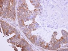 BHMT Antibody - BHMT antibody detects BHMT protein at cytosol on Colon Carcinoma by immunohistochemical analysis. Sample: Paraffin-embedded Colon Carcinoma. BHMT antibody dilution:1:500.