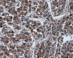 BHMT Antibody - Immunohistochemical staining of paraffin-embedded Carcinoma of liver tissue using anti-BHMT mouse monoclonal antibody. (Dilution 1:50).