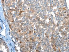 BHMT2 Antibody - Immunohistochemistry of paraffin-embedded Human liver cancer tissue  using BHMT2 Polyclonal Antibody at dilution of 1:45(×200)
