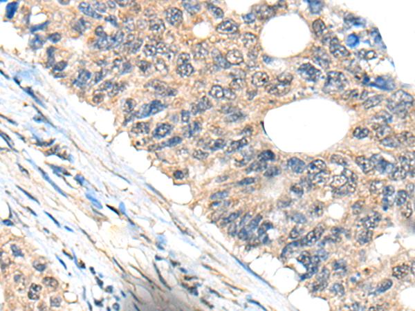 BHMT2 Antibody - Immunohistochemistry of paraffin-embedded Human colorectal cancer tissue  using BHMT2 Polyclonal Antibody at dilution of 1:45(×200)