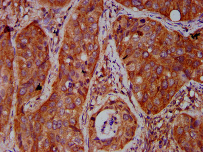 BICD2 Antibody - Immunohistochemistry Dilution at 1:500 and staining in paraffin-embedded human cervical cancer performed on a Leica BondTM system. After dewaxing and hydration, antigen retrieval was mediated by high pressure in a citrate buffer (pH 6.0). Section was blocked with 10% normal Goat serum 30min at RT. Then primary antibody (1% BSA) was incubated at 4°C overnight. The primary is detected by a biotinylated Secondary antibody and visualized using an HRP conjugated SP system.