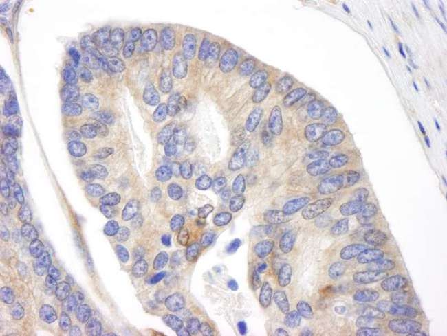 BID Antibody - Detection of Human BID by Immunohistochemistry. Sample: FFPE section of human prostate adenocarcinoma. Antibody: Affinity purified rabbit anti-BID used at a dilution of 1:250.
