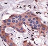 BID Antibody - Formalin-fixed and paraffin-embedded human cancer tissue reacted with the primary antibody, which was peroxidase-conjugated to the secondary antibody, followed by DAB staining. This data demonstrates the use of this antibody for immunohistochemistry; clinical relevance has not been evaluated. BC = breast carcinoma; HC = hepatocarcinoma.