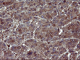 BID Antibody - IHC of paraffin-embedded Carcinoma of Human liver tissue using anti-BID mouse monoclonal antibody. (Heat-induced epitope retrieval by 10mM citric buffer, pH6.0, 120°C for 3min).