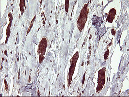 BID Antibody - IHC of paraffin-embedded Adenocarcinoma of Human breast tissue using anti-BID mouse monoclonal antibody. (Heat-induced epitope retrieval by 10mM citric buffer, pH6.0, 120°C for 3min).