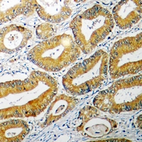 BID Antibody - Immunohistochemical analysis of BID staining in human colon cancer formalin fixed paraffin embedded tissue section. The section was pre-treated using heat mediated antigen retrieval with sodium citrate buffer (pH 6.0). The section was then incubated with the antibody at room temperature and detected using an HRP polymer system. DAB was used as the chromogen. The section was then counterstained with hematoxylin and mounted with DPX.