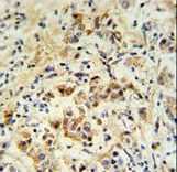 BID Antibody - mouse BID Antibody (S61) IHC of formalin-fixed and paraffin-embedded human breast carcinoma followed by peroxidase-conjugated secondary antibody and DAB staining.