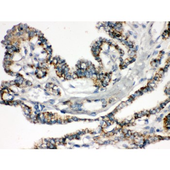 BIK Antibody - Bik antibody IHC-paraffin. IHC(P): Human Thyroid Cancer Tissue.