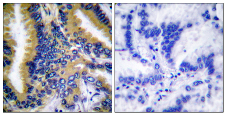 BIK Antibody - Immunohistochemistry analysis of paraffin-embedded human lung carcinoma tissue, using BIK Antibody. The picture on the right is blocked with the synthesized peptide.