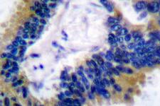 BIK Antibody - IHC of BIK (M27) pAb in paraffin-embedded human lung carcinoma tissue.
