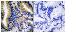 BIK Antibody - Peptide - + Immunohistochemical analysis of paraffin-embedded human breast carcinoma tissue using BIK (Ab-33) antibody.