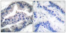BIK Antibody - Immunohistochemistry analysis of paraffin-embedded human lung carcinoma, using BIK (Phospho-Thr33) Antibody. The picture on the right is blocked with the phospho peptide.