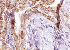 BIK Antibody - 1:100 staining human Thyroid carcinoma tissue by IHC-P. The tissue was formaldehyde fixed and a heat mediated antigen retrieval step in citrate buffer was performed. The tissue was then blocked and incubated with the antibody for 1.5 hours at 22°C. An HRP conjugated goat anti-rabbit antibody was used as the secondary.