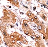 BIK Antibody - Formalin-fixed and paraffin-embedded human cancer tissue reacted with the primary antibody, which was peroxidase-conjugated to the secondary antibody, followed by AEC staining. This data demonstrates the use of this antibody for immunohistochemistry; clinical relevance has not been evaluated. BC = breast carcinoma; HC = hepatocarcinoma.