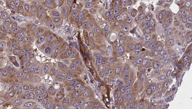 BIN2 Antibody - 1:100 staining human liver carcinoma tissues by IHC-P. The sample was formaldehyde fixed and a heat mediated antigen retrieval step in citrate buffer was performed. The sample was then blocked and incubated with the antibody for 1.5 hours at 22°C. An HRP conjugated goat anti-rabbit antibody was used as the secondary.