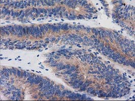 BIN3 Antibody - IHC of paraffin-embedded Adenocarcinoma of Human endometrium tissue using anti-BIN3 mouse monoclonal antibody.