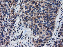 BIN3 Antibody - IHC of paraffin-embedded Carcinoma of Human bladder tissue using anti-BIN3 mouse monoclonal antibody.