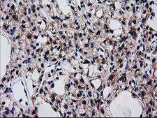 BIN3 Antibody - IHC of paraffin-embedded Carcinoma of Human kidney tissue using anti-BIN3 mouse monoclonal antibody.