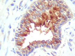 BIRC3 / cIAP2 Antibody - cIAP2/HIAD1 Antibody - IHC of human adenocarcinoma cells and adjacent glands using anti-cIAP2.  This image was taken for the unconjugated form of this product. Other forms have not been tested.
