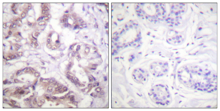 BIRC5 / Survivin Antibody - Immunohistochemistry analysis of paraffin-embedded human breast carcinoma tissue, using Survivin Antibody. The picture on the right is blocked with the synthesized peptide.