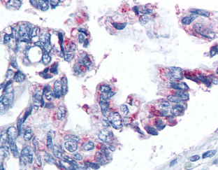 BIRC5 / Survivin Antibody - Lung, Cancer 60X.  This image was taken for the unconjugated form of this product. Other forms have not been tested.