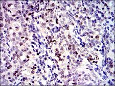 BIRC5 / Survivin Antibody - IHC of paraffin-embedded cervical cancer tissues using BIRC5 mouse monoclonal antibody with DAB staining.