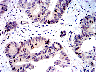 BIRC5 / Survivin Antibody - IHC of paraffin-embedded colon cancer tissues using BIRC5 mouse monoclonal antibody with DAB staining.