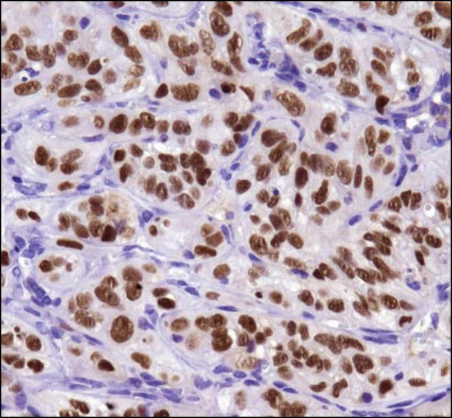 BIRC5 / Survivin Antibody - Immunohistochemistry: Survivin Antibody (8E2) - Analysis of Survivin in human breast cancer using DAB with hematoxylin counterstain.  This image was taken for the unconjugated form of this product. Other forms have not been tested.