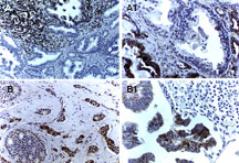 BIRC5 / Survivin Antibody - IHC of Survivin in formalin-fixed, paraffin-embedded human prostate and breast cancer using Polyclonal Antibody to Survivin at 1:2000. A and A1, prostate cancer at low and high magnification, respectively. B and B1, breast cancer. B1 is a high magnification of an area of metastasis. Hematoxylin-Eosin counterstain.