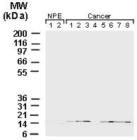 BIRC5 / Survivin Antibody - Western blot of Survivin in normal prostate epithelium (NPE) and prostate cancer using Polyclonal Antibody to Survivin at 1:2000. 100 ug/lane of each human tissue lysate was loaded per lane. Survivin was detected in 7 out of 8 prostate cancer patient specimens, but was not detected in NPE.