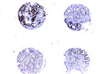 BIRC5 / Survivin Antibody - IHC of Survivin in a formalin-fixed, paraffin-embedded human prostate cancer array Polyclonal Antibody to Survivin at 1:2000. A1 is a high magnification of A. Differential expression of Survivin is seen in tissue cores from four different prostate cancer patients. Hematoxylin-Eos in counterstain.