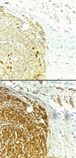 BIRC5 / Survivin Antibody - The top photo is a no primary antibody control stain and the bottom photo is anti-survivin staining of melanoma.  This image was taken for the unconjugated form of this product. Other forms have not been tested.