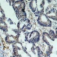 BIRC5 / Survivin Antibody - Immunohistochemical analysis of Survivin staining in human colon cancer formalin fixed paraffin embedded tissue section. The section was pre-treated using heat mediated antigen retrieval with sodium citrate buffer (pH 6.0). The section was then incubated with the antibody at room temperature and detected using an HRP conjugated compact polymer system. DAB was used as the chromogen. The section was then counterstained with hematoxylin and mounted with DPX.