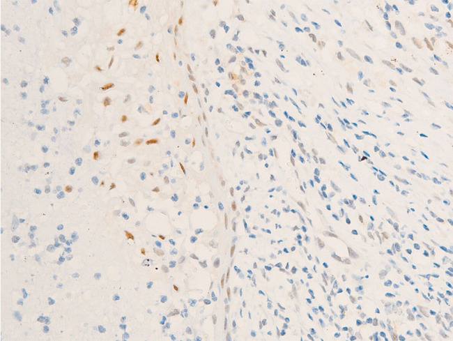 BIRC5 / Survivin Antibody - 1:100 staining human TB tissue by IHC-P. The tissue was formaldehyde fixed and a heat mediated antigen retrieval step in citrate buffer was performed. The tissue was then blocked and incubated with the antibody for 1.5 hours at 22°C. An HRP conjugated goat anti-rabbit antibody was used as the secondary.