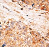 BIRC7 / Livin Antibody - Formalin-fixed and paraffin-embedded human cancer tissue reacted with the primary antibody, which was peroxidase-conjugated to the secondary antibody, followed by AEC staining. This data demonstrates the use of this antibody for immunohistochemistry; clinical relevance has not been evaluated. BC = breast carcinoma; HC = hepatocarcinoma.
