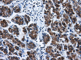 BIRC7 / Livin Antibody - IHC of paraffin-embedded Carcinoma of liver tissue using anti-BI mouse monoclonal antibody. (Dilution 1:50).