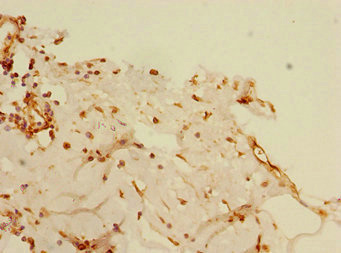 BLID Antibody - Immunohistochemistry of paraffin-embedded human breast cancer at dilution 1:100