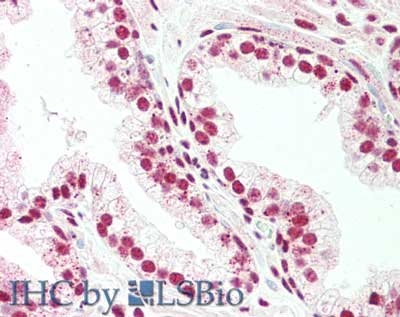 BLIMP1 / PRDM1 Antibody - Immunohistochemistry of rabbit anti-PRDM1-BLMP1 antibody. Tissue: prostate. Fixation: formalin fixed paraffin embedded. Antigen retrieval: not required. Primary antibody: Anti-PRDM1-BLMP1 at 5 µg/mL for 1 h at RT. Secondary antibody: Peroxidase rabbit secondary antibody at 1:10,000 for 45 min at RT. Staining: PRDM1-BLMP1 as precipitated red signal with hematoxylin purple nuclear counterstain.