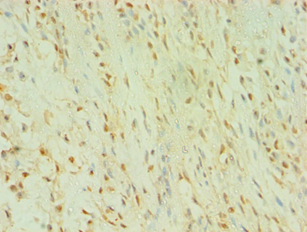 BLK Antibody - Immunohistochemistry of paraffin-embedded human breast cancer using antibody at 1:100 dilution.