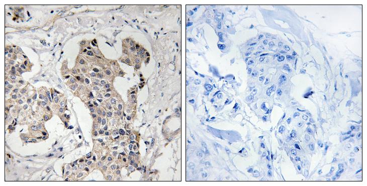 BLK Antibody - Peptide - + Immunohistochemistry analysis of paraffin-embedded human breast carcinoma tissue using BLK antibody.