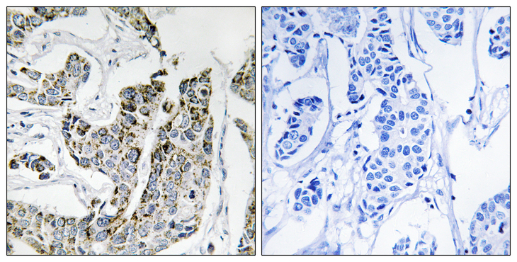 BLK Antibody - Immunohistochemistry analysis of paraffin-embedded human breast carcinoma, using BLK (Phospho-Tyr501) Antibody. The picture on the right is blocked with the phospho peptide.