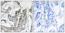 BLK Antibody - P-peptide - + Immunohistochemistry analysis of paraffin-embedded human breast carcinoma tissue using BLK (Phospho-Tyr501) antibody. BLK (Phospho-Tyr501) antibody reacts with epitope-specific phosphopeptide and corresponding non-phosphopeptide.