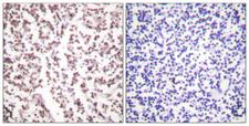 BLM Antibody - Immunohistochemistry analysis of paraffin-embedded human lymph node tissue, using Bloom Syndrome Antibody. The picture on the right is blocked with the synthesized peptide.