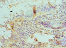 BLMH Antibody - Immunohistochemistry of paraffin-embedded human colon cancer using antibody at 1:100 dilution.